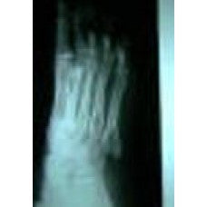 Pedorthic Case Studies II - Webcast